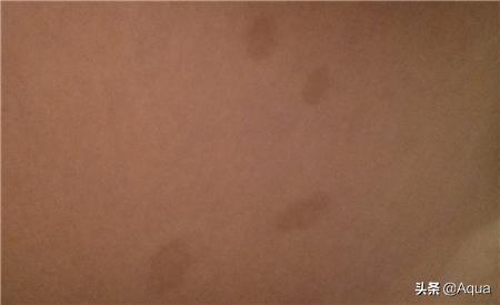 花斑癣图片（花斑癣图片头上）